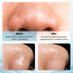 Extractor Espinilla Hidrafacial - Imagen 5