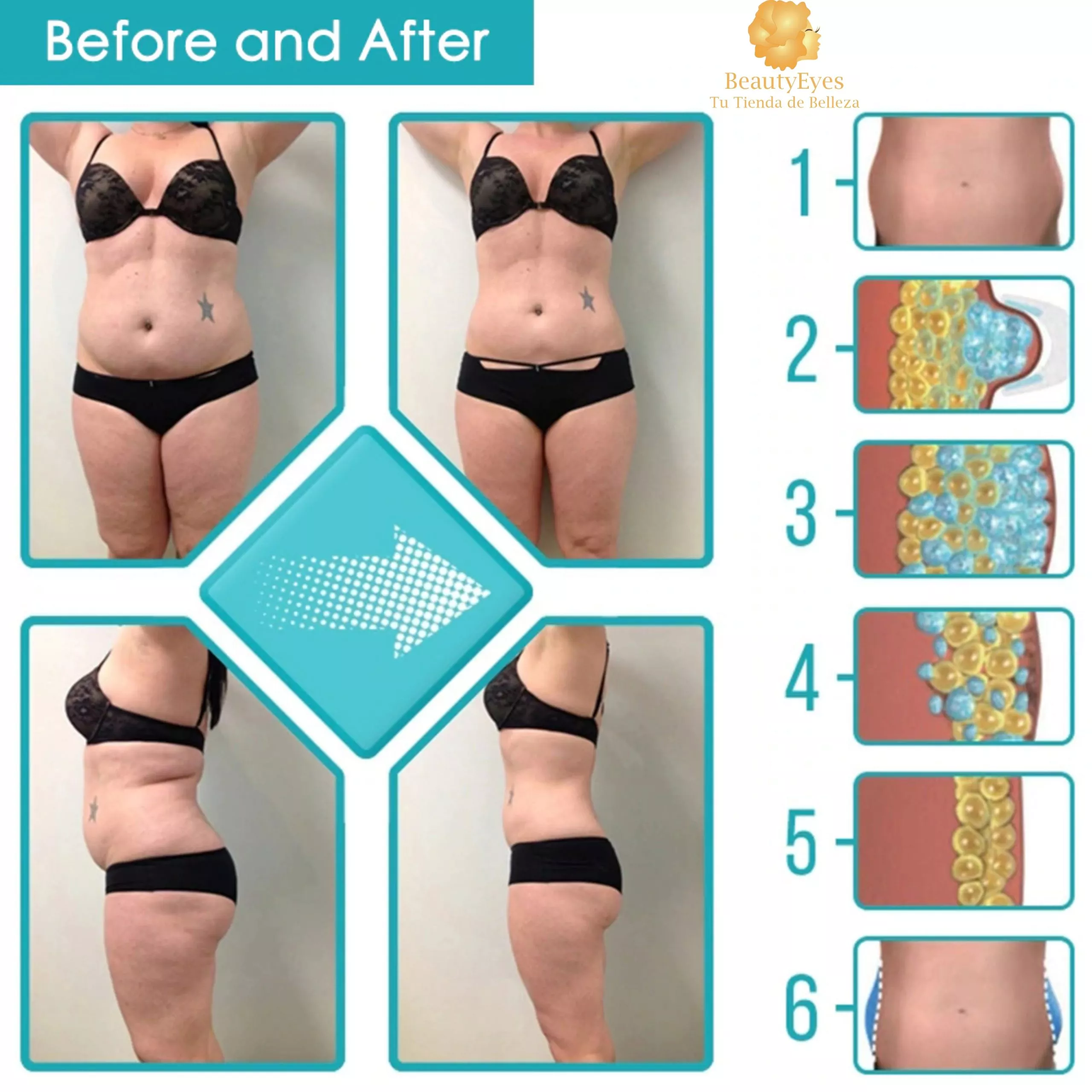 Criolipolisis Portatil Reductor Corporal Crioterapia - Imagen 6