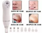 Diamond Peeling Microdermoabrasion Facial Corporal - Imagen 4